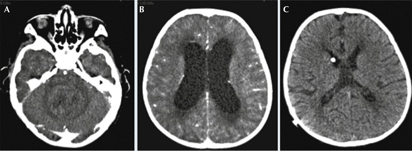Cortes axiales de tomograf&iacute;a computada de cr&aacute;neo con contraste. A)
              Tumor heterog&eacute;neo que ocupa y expande al cuarto ventr&iacute;culo; B) Compresi&oacute;n
              de las estructuras circundantes, gran dilataci&oacute;n ventricular y moderado edema
              transependimario. C) Tomograf&iacute;a computada de cr&aacute;neo simple
              post-derivaci&oacute;n, hay disminuci&oacute;n en la talla ventricular supratentorial y en el edema
              transependimario.