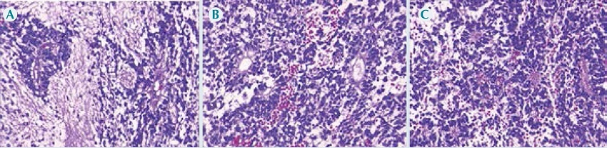 Biopsia del tumor cerebral. A) Pseudo-rosetas perivasculares y zonas
              paucicelulares con abundante malla fibrilar. B) Rosetas ependimarias en
              zonas hipercelulares y escasa malla fibrilar. C) Rosetas con malla
              fibrilar dentro de las luces en una zona hipercelular.