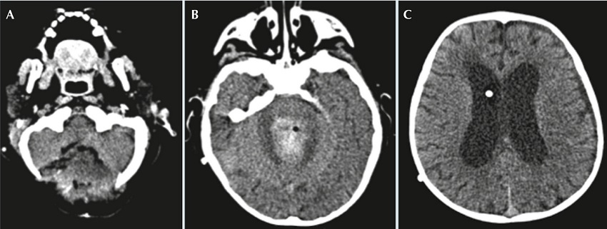 A) Tomograf&iacute;a computada post craneotom&iacute;a occipital. B)
              Resecci&oacute;n parcial de la tumoraci&oacute;n intraventricular con hematoma hiperdenso residual
              en el lecho quir&uacute;rgico. C) Nuevo incremento en la talla
              ventricular.