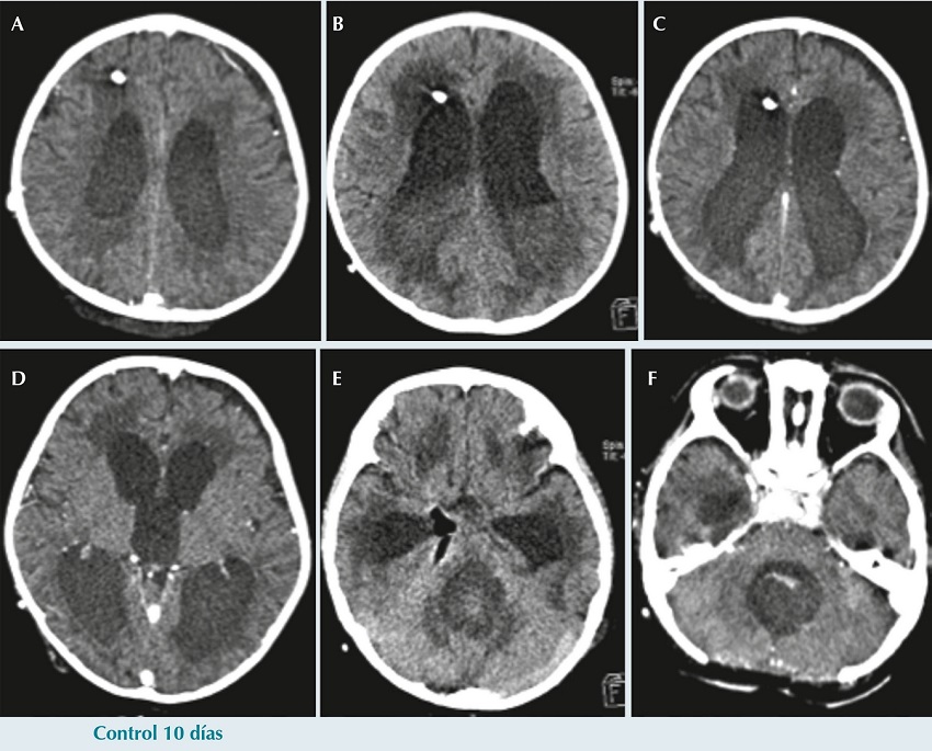 Tomograf&iacute;a computada con y sin contraste de control en el d&iacute;a 10 post
              craniectom&iacute;a. Se identifica una mayor dilataci&oacute;n ventricular con incremento en el
              edema transependimario, y un nivel l&iacute;quido-l&iacute;quido al interior de los ventr&iacute;culos
              (flecha en B) con un material de mayor densidad en la porci&oacute;n m&aacute;s
              declive. Se visualiza adem&aacute;s gas en la cisterna ambiens (flecha en E).
              Hay disminuci&oacute;n en la densidad del hematoma del lecho quir&uacute;rgico en
              F.
