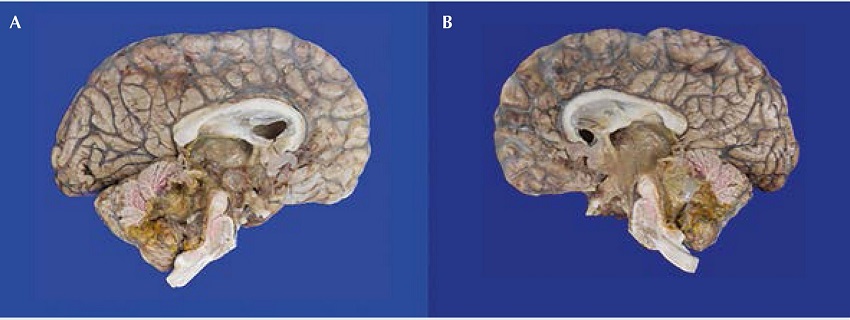 Enc&eacute;falo. A) Corte sagital hemisferio izquierdo. B)
              Corte sagital hemisferio derecho.