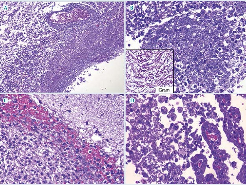 Meningoependimocoroiditis. A) Pared ventricular con necrosis y
              hemorragia antigua; B) supuraci&oacute;n con bacterias Gram negativas;
                C) piamadre; D) plexos coroides. En todos se observa un
              proceso inflamatorio supurativo asociado con infecci&oacute;n por Pseudomonas
                aeruginosa.