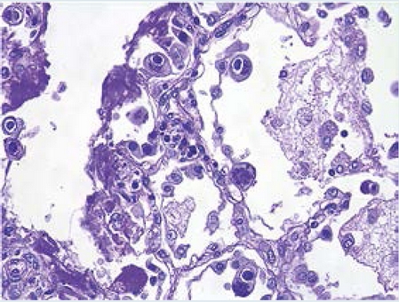 Citomegalovirus: inclusiones pulmonares nucleares (bien definidas) y
              citopl&aacute;smicas (mal definidas). Tinci&oacute;n con &aacute;cido pery&oacute;dico de Schiff.
