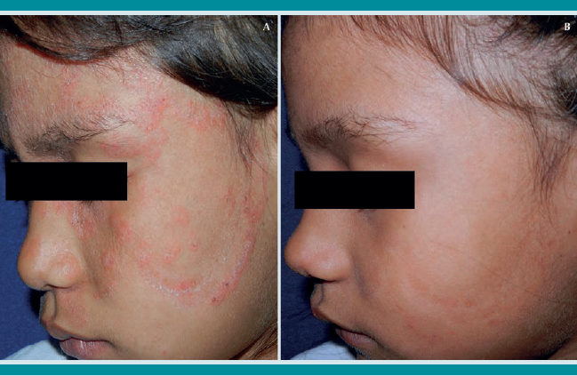 a) Lesiones eritematodescamativas producidas por T. verrucosum. b) Un mes después con terbinafina tópica y griseofulvina oral.