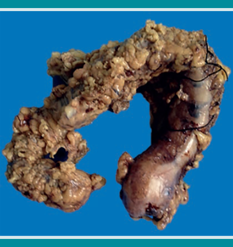Espécimen de colectomía. El tejido adiposo de la serosa es abundante y de aspecto nodular irregular.