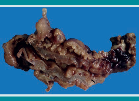 Segmento de intestino delgado al corte, con disminución del calibre de su luz y pared irregularmente engrosada.