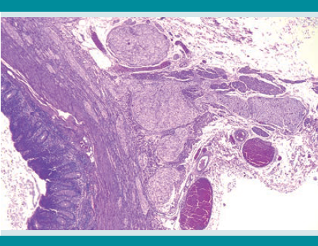 En la serosa y en la grasa pericolónica se observan nódulos de gran tamaño. Los plexos mientéricos se aprecian muy irregulares. A la izquierda se identifica mucosa colónica normal.
