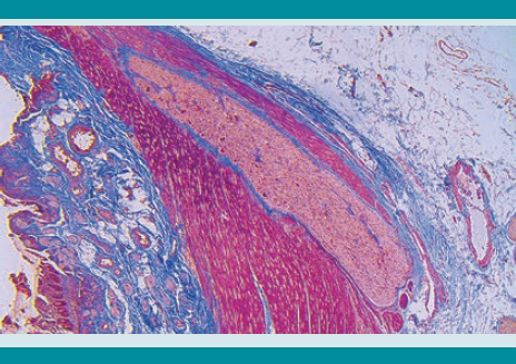 Con tinción de Masson se observa un cordón grueso que afecta a la muscular y serosa y tiene numerosas células ganglionares irregulares.