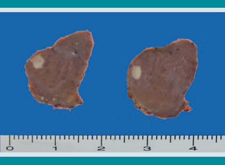 Ambos lóbulos tiroideos al corte. Cada uno muestra un nódulo tumoral de 0.2 cm.