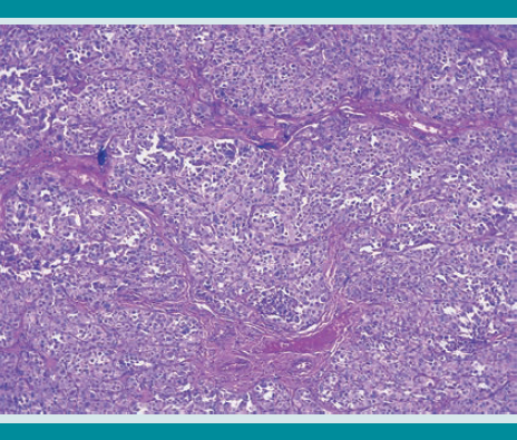 Aspecto microscópico de la neoplasia. Es evidente el patrón lobular y moderado pleomorfismo.