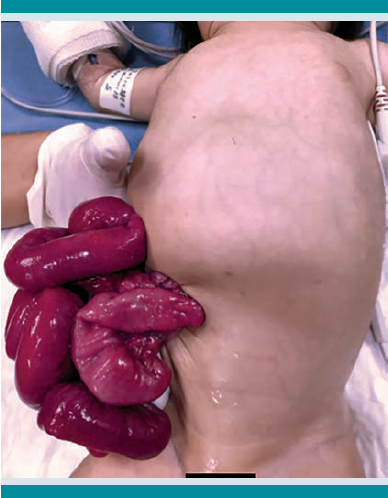Hernia umbilical rota con intestino eviscerado.