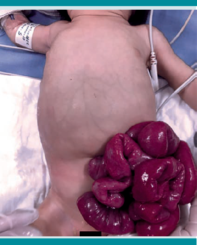 Hernia umbilical rota con intestino eviscerado.
