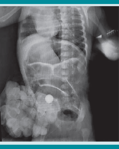 Radiografía toracoabdominal anteroposterior con cuerpo extraño (canica) en la cavidad abdominal.