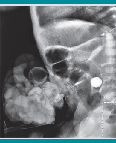 Radiografía lateral de abdomen con cuerpo extraño (canica) en la cavidad abdominal