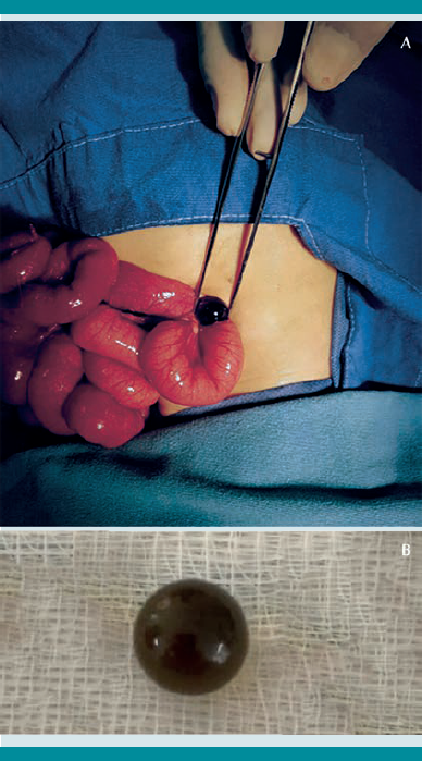 Extracción del cuerpo extraño (canica) de la cavidad abdominal (A). Canica extraída (B).