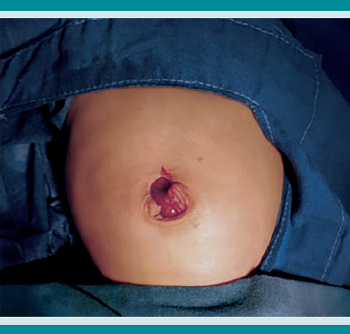 Imagen posterior a la introducción del intestino delgado eviscerado a la cavidad.