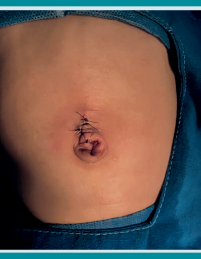 Resultado posterior a la umbilicoplastia.