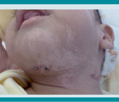 Mancha hipocrómica en la región cervical anterior que sigue las líneas de la piel.