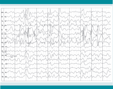 Electroencefalograma con asimetría interhemisférica por ritmo y voltaje, y paroxismos frecuentes en la región frontoparietal izquierda.