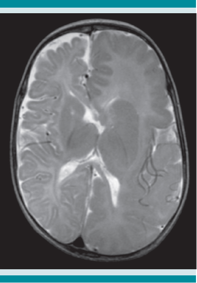 Resonancia magnética en secuencia T2, corte axial que muestra aumento de tamaño del ventrículo izquierdo (sobrepasa la línea media) y paquigiria en la región frontoparietal