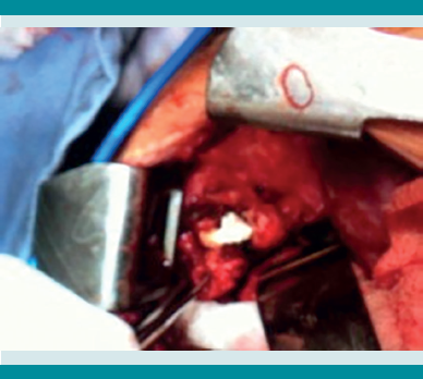 Corporectomía T7-T8, resección y toma de cultivo de granuloma.