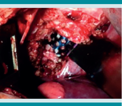 Aplicación de malla de titanio con injerto autólogo y matriz ósea.