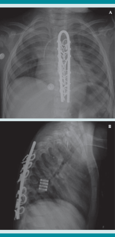 (A) Radiografía posquirúrgica anteroposterior, (B) Radiografía posquirúrgica lateral.