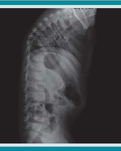 Radiografía lateral de la columna vertebral.