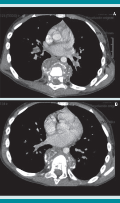 (A) Izquierda, TAC, corte transversal de T7 absceso paravertebral anterior. (B) Derecha, TAC, corte transversal de T8 absceso paravertebral anterior.