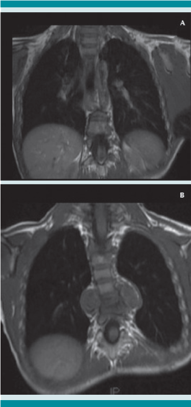 Resonancia magnética (A-B) corte coronal de tórax, absceso paravertebral anterior con acuñamiento.
