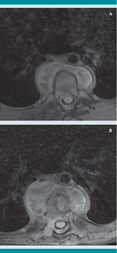 (A) Izquierda, resonancia magnética, corte transversal de T7 absceso paravertebral anterior. (B) Derecha, resonancia, corte transversal de T8 absceso paravertebral anterior, afectación ósea en el cuerpo vertebral.
