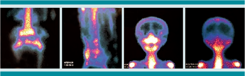 Gammagrafía ósea, no concluyente de diagnóstico.