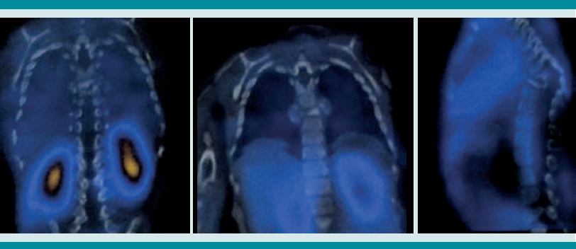SPECT no concluyente de patología con antibiótico radiomarcado.