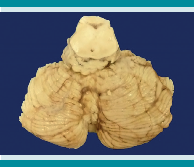 Lesi&oacute;n tumoral a nivel de los ped&uacute;nculos cerebrales