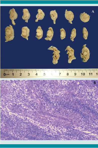 A. Cortes transversales de la m&eacute;dula espinal con tumor subaracnoideo. B. Imagen de la histolog&iacute;a del tumor con el estroma mixoide con la disposici&oacute;n radial de las c&eacute;lulas neopl&aacute;sicas.