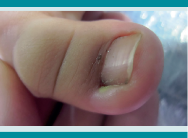 U&ntilde;a con irritaci&oacute;n e inflamaci&oacute;n.