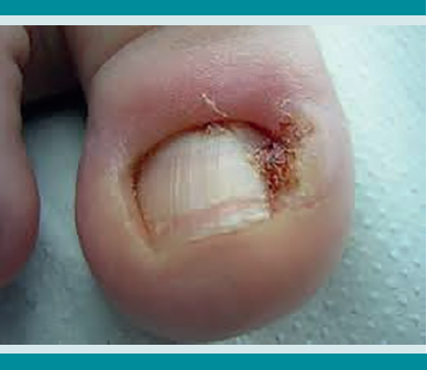 Pliegue lateral de la u&ntilde;a inflamado y con secreci&oacute;n serohem&aacute;tica.