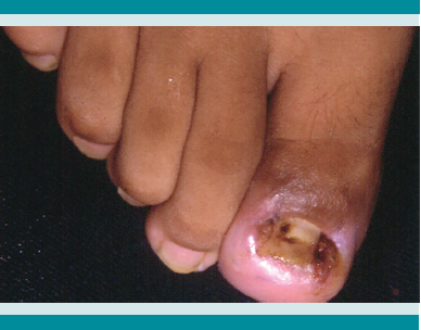 Deformaci&oacute;n de la l&aacute;mina ungueal que comprime los tejidos blandos.3