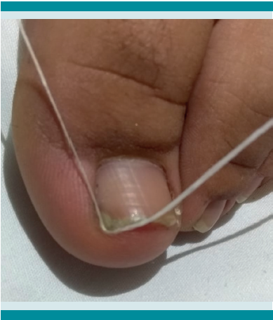 Colocaci&oacute;n de hilo dental.