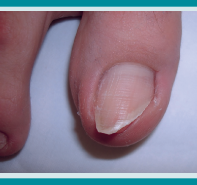 Corte incorrecto de las u&ntilde;as.