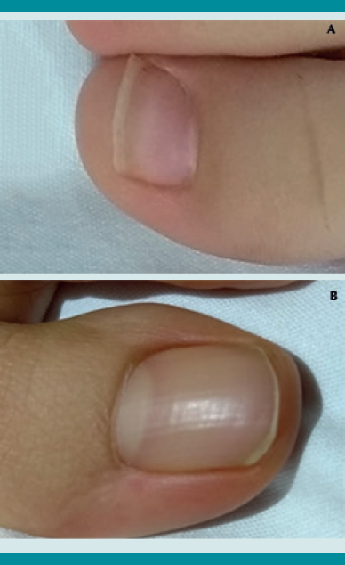 Corte correcto de las u&ntilde;as (A y B).
