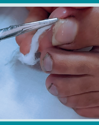Colocaci&oacute;n de gasas vaselinadas en el extremo distal de la u&ntilde;a (f&eacute;rula flexible).