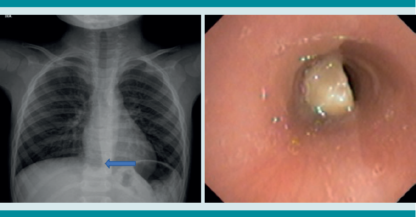 Paciente masculino de 2 a&ntilde;os, 5 meses, con atragantamiento y cianosis mientras com&iacute;a cacahuates y jugaba. En el hospital observaron que la radiograf&iacute;a de t&oacute;rax no mostraba alguna anormalidad, por eso lo dieron de alta, solo con ibuprofeno y salbutamol. Ante la persistencia de la tos otra radiograf&iacute;a de t&oacute;rax mostr&oacute; sobredistenci&oacute;n pulmonar bilateral, herniaci&oacute;n del par&eacute;nquima pulmonar derecho sobre la l&iacute;nea media (flecha). La broncoscopia puso de manifiesto el cuerpo extra&ntilde;o biol&oacute;gico en el tercio superior de la tr&aacute;quea. Se extrajo sin complicaciones.