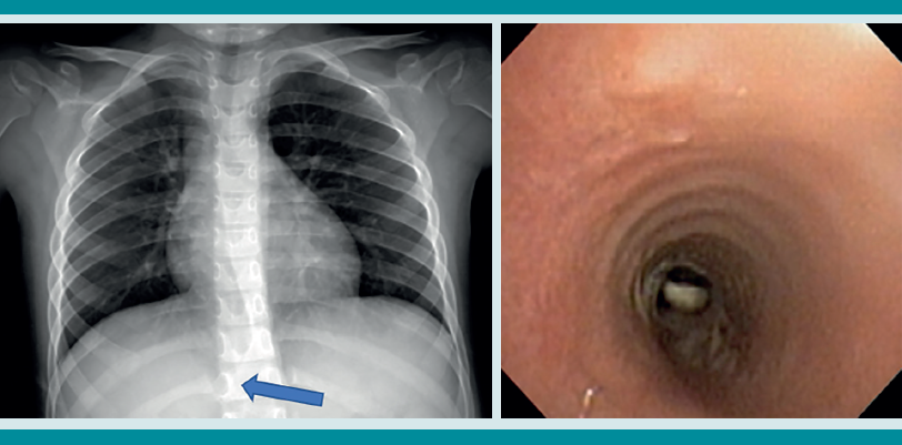 Paciente femenina de 4 a&ntilde;os 11 meses. Tos y dificultad respiratoria mientras corr&iacute;a y com&iacute;a cacahuates. Tuvo fiebre, tos y sibilancias. Fue llevada al hospital y solo le indicaron un antibi&oacute;tico y salbutamol. Ante la persistencia de los s&iacute;ntomas por tres semanas se volvi&oacute; a tomar una nueva radiograf&iacute;a de t&oacute;rax: sobredistenci&oacute;n pulmonar bilateral, herniaci&oacute;n del par&eacute;nquima pulmonar derecho sobre la l&iacute;nea media que sobrepasa el hemidiafragma (flecha)). La broncoscopia puso de manifiesto un cuerpo extra&ntilde;o biol&oacute;gico en el tercio inferior de la tr&aacute;quea. Se extrajo sin complicaciones.