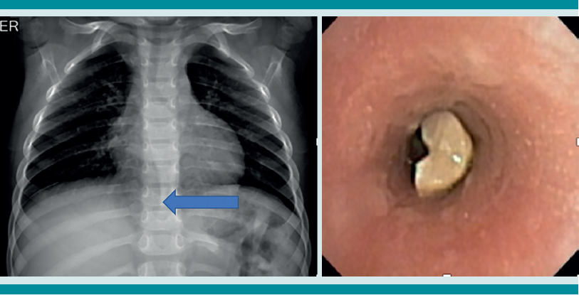 Paciente masculino de 2 a&ntilde;os, con tos y cianosis mientras jugaba y com&iacute;a cacahuates. En el hospital le tomaron una radiograf&iacute;a y lo dieron de alta con la sola indicaci&oacute;n de un antibi&oacute;tico. Ante la persistencia de la tos se le tom&oacute; una nueva radiograf&iacute;a de t&oacute;rax que mostr&oacute; sobredistenci&oacute;n pulmonar bilateral, herniaci&oacute;n del par&eacute;nquima pulmonar derecho sobre la l&iacute;nea media (flecha). La broncoscopia advirti&oacute; la existencia de un cuerpo extra&ntilde;o biol&oacute;gico en el tercio superior de la tr&aacute;quea. Se extrajo sin complicaciones.