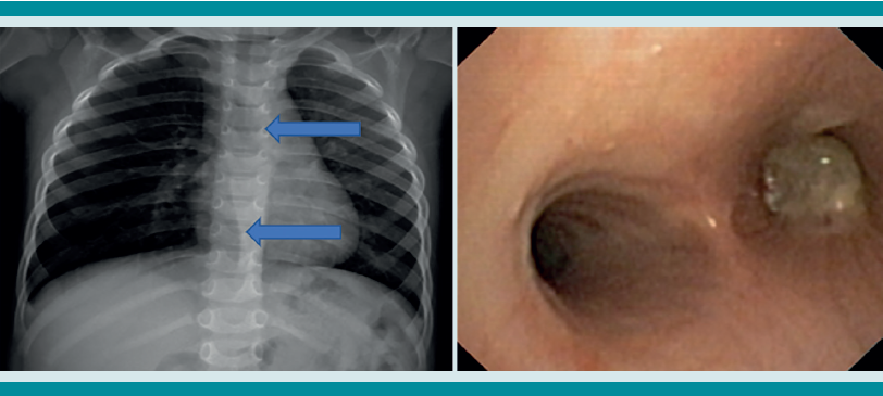 Paciente masculino de 2 a&ntilde;os 6 meses con tos, dificultad respiratoria y cianosis mientras com&iacute;a cacahuates y corr&iacute;a. La radiograf&iacute;a de t&oacute;rax mostr&oacute;: asimetr&iacute;a por sobredistenci&oacute;n del hemit&oacute;rax derecho, con aumento en la radiolucidez y herniaci&oacute;n del par&eacute;nquima que sobrepasaba la l&iacute;nea media y el hemidiafragma (flechas). La broncoscopia advirti&oacute; la existencia de un cuerpo extra&ntilde;o biol&oacute;gico en el bronquio principal derecho. Se extrajo sin complicaciones.