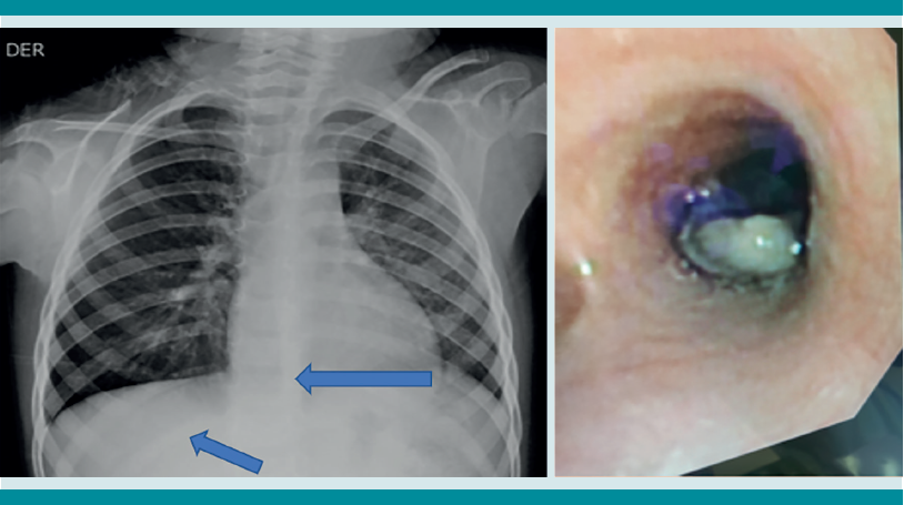Paciente femenina de 3 a&ntilde;os 9 meses. Mientras jugaba tuvo un cuadro de tos s&uacute;bita, dificultad respiratoria y cianosis. En el Centro de Salud le administraron salbutamol por sibilancias; la dieron de alta. Permaneci&oacute; cuatro meses con tos, fiebre, sibilancias y m&uacute;ltiples tratamientos para el asma y neumon&iacute;a. La radiograf&iacute;a de t&oacute;rax mostr&oacute; sobredistenci&oacute;n en el hemit&oacute;rax derecho, herniaci&oacute;n del par&eacute;nquima que sobrepasaba la l&iacute;nea media y el hemidiafragma (flechas). La broncoscopia mostr&oacute; un cuerpo extra&ntilde;o biol&oacute;gico en el bronquio principal derecho. Se extrajo sin complicaciones.