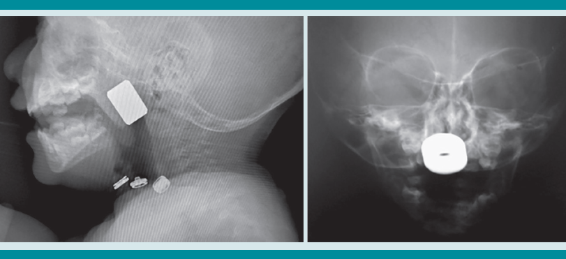 Paciente masculino de 2 a&ntilde;os, con un cuerpo extra&ntilde;o met&aacute;lico empujado por la madre hacia la nasofaringe al intentar sacarlo con el dedo. INP 2018.