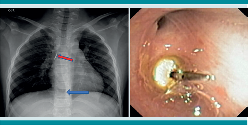 Paciente masculino de 12 a&ntilde;os que s&uacute;bitamente tuvo un acceso de tos y dificultad respiratoria luego de &ldquo;tragarse&rdquo; una tachuela que sosten&iacute;a en la boca. La radiograf&iacute;a de t&oacute;rax mostr&oacute; herniaci&oacute;n del par&eacute;nquima pulmonar derecho que sobrepasaba la l&iacute;nea media (flecha azul). Imagen opaca (densidad metal) en la regi&oacute;n del bronquio principal derecho (flecha roja). La broncoscopia mostr&oacute; un cuerpo extra&ntilde;o met&aacute;lico en el bronquio principal derecho. Se extrajo sin complicaciones.