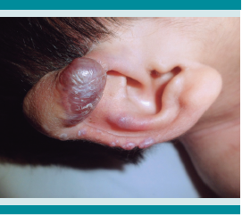 N&oacute;dulos de coloraci&oacute;n viol&aacute;cea en h&eacute;lix en los pabellones auriculares, t&iacute;picos del s&iacute;ndrome de fibromatosis hialina.